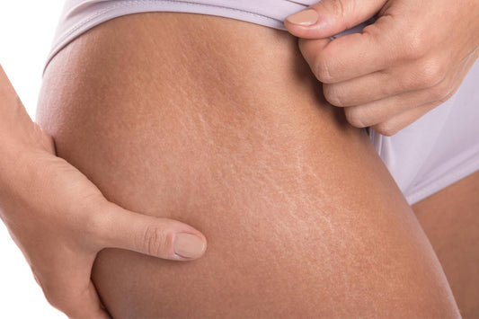 Como Prevenir y Tratar Las Estrías