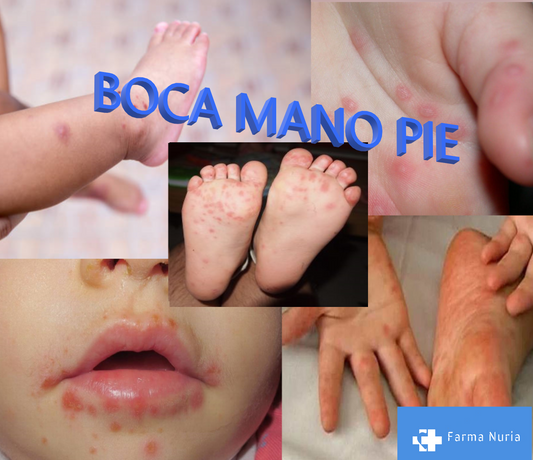 Virus Boca Mano Pie: Síntomas Prevención y Tratamiento