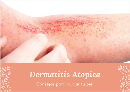 CONSEJOS PARA CUIDAR LA PIEL CON DERMATITIS ATÓPICA